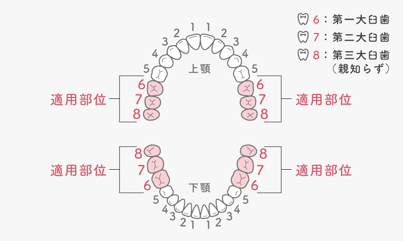 保険適用PEEK冠